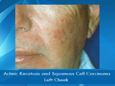 Actinic Keratosis treatment