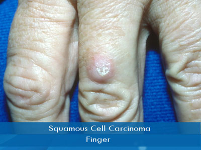 Actinic Keratosis treatment