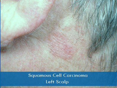 Actinic Keratosis treatment