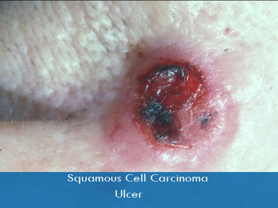 Actinic Keratosis treatment