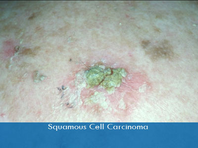 Actinic Keratosis treatment