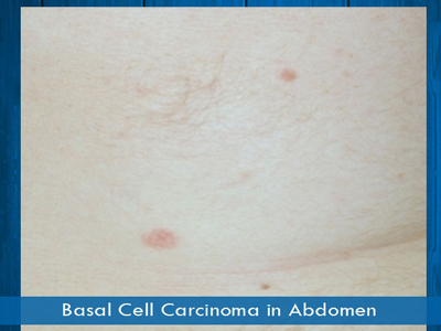Basal Cell Carcinomas - abdomen