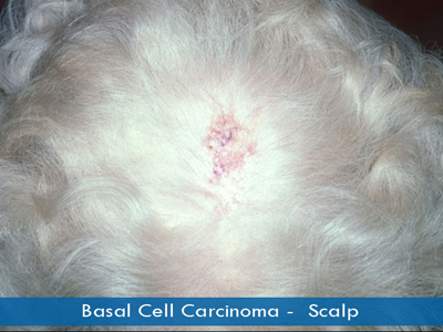 Basal Cell Carcinomas - scalp