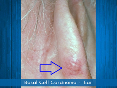 Basal Cell Carcinomas - ear