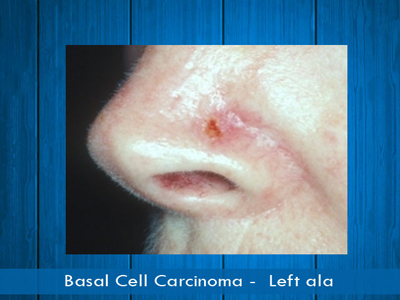 Basal Cell Carcinomas - left ala