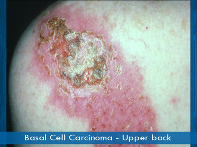 Basal Cell Carcinomas - upper back