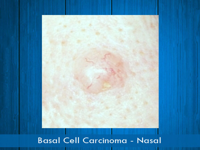Basal Cell Carcinomas nasal