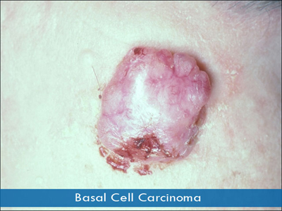 Basal Cell Carcinomas