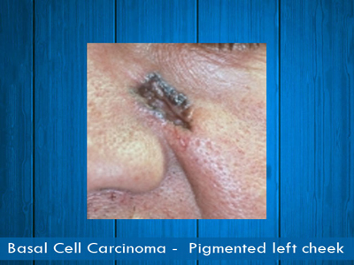Basal Cell Carcinomas