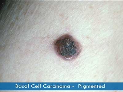 Basal Cell Carcinomas