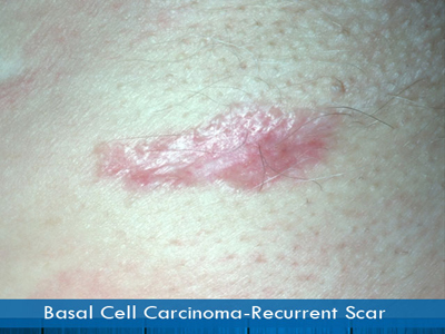 Basal Cell Carcinomas