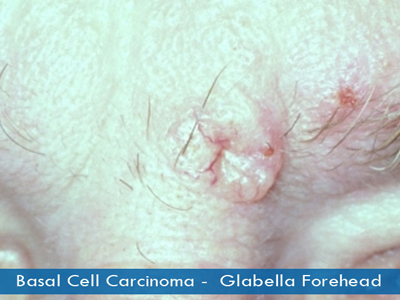 Basal Cell Carcinomas - glabella forehead