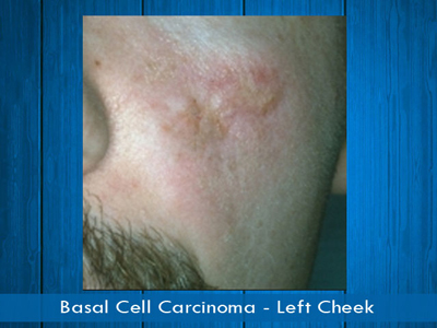 Basal Cell Carcinomas - left cheek
