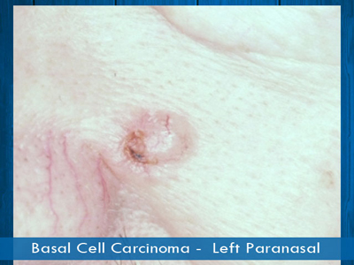 Basal Cell Carcinomas