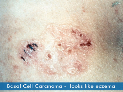 Basal Cell Carcinomas
