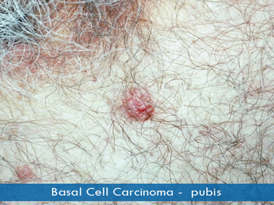 Basal Cell Carcinomas - pubic