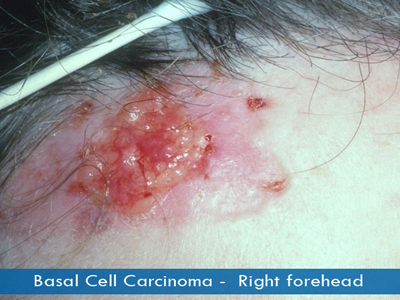 Basal Cell Carcinomas - right forehead