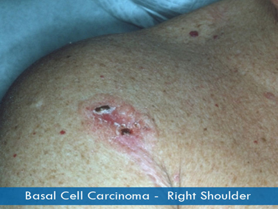 Basal Cell Carcinomas - right shoulder