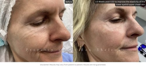 3.5 Weeks post CO2 to improve the elasticity of the lower eyelid/upper cheek skin