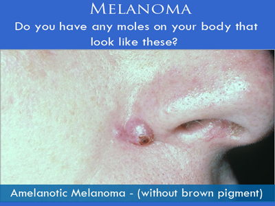 Melanoma Surgery in NYC