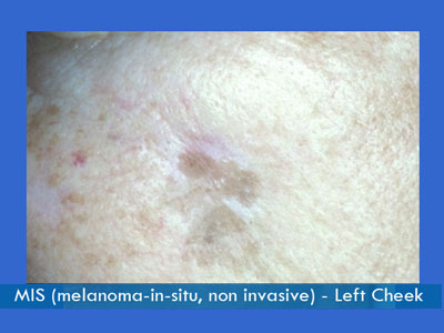 Melanoma Surgery in NYC