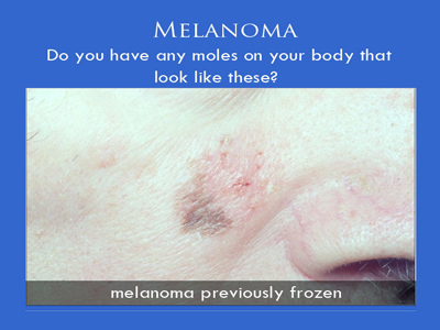 Melanoma Surgery in NYC