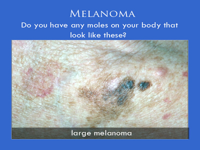 Melanoma Surgery in NYC