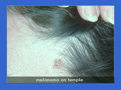 Melanoma Surgery in NYC