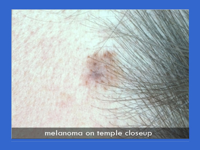 Melanoma Surgery in NYC