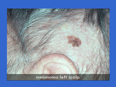 Melanoma Surgery in NYC