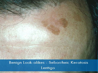 Seborrheic Keratosis