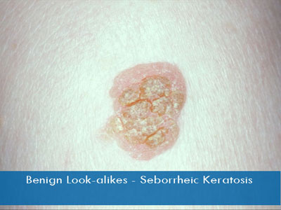 Seborrheic Keratosis