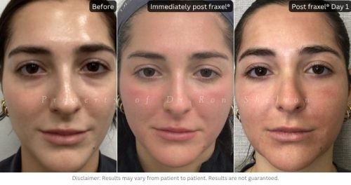 Using dual wavelengths (1550 nm + 1927 nm), Dr. Ron Shelton treated this 23-year-old patient to improve texture, pores, and sun damage.Photos show progression from before treatment, immediately after, and post-operative day 9, demonstrating gradual improvement in clarity and skin brilliance.