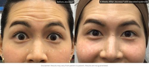 These before-and-after photos show the forehead with the eyebrows elevated. Some forehead lines are intentionally left to maintain natural eyebrow movement and prevent the eyebrows from dropping, helping achieve a balanced, natural-looking result.